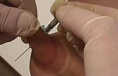 torture tit needles
