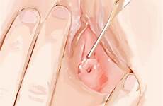 urethra insertion urethral swab respond