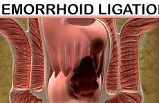 medical hemorrhoid band ligation rubber videos