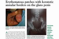 glans patches keratotic annular borders erythematous