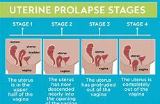 prolapse uterine stages uterus pelvic prolapsed