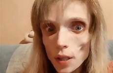 anorexic anorexia corpse cen kristina thanked recorded