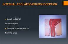 prolapse rectal intussusception rectum occult anus