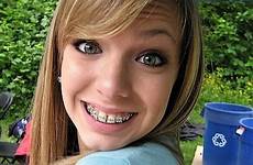 braces brace orthodontics retainers