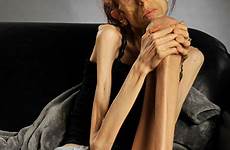 farrokh anorexia woman rachael california now person battle her racheal photography story farokh describes claude peggy pierre