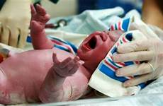 kopf inknippen tijdens bevalling zwanger samen labour blutige schwellung neugeborenen alabama permanently injured
