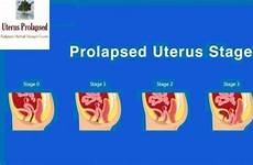 prolapse pelvic uterus stages organ uterine prolapsed vaginal occurs pristyn