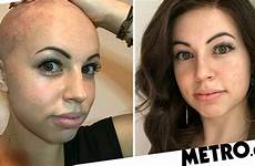 trichotillomania shaved head her woman metro