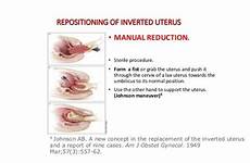 prolapse uterine uterus reduction vaginal repositioning inverted fist