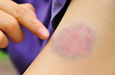 bruise bruises fade remedies themselves usually recovery speed