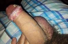 smegma penis tumbex foreskin unwashed smelly filthy