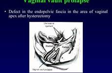 vaginal prolapse nulliparous operations mob fascia