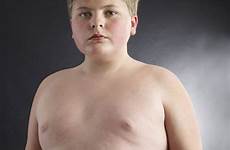 fat children obese weight kid surgery child obesity outrage numbers loss useful needing grow getty patient