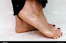soles dry cracked background womans barefoot podiatry