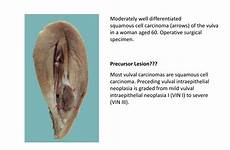 female genital vulva pathology tract vulval woman lesion carcinoma precursor ppt powerpoint presentation