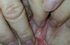 clitoral glans smegma
