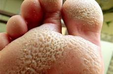 pitted keratolysis smelly infection bacterial soles hands treatment