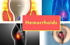hemorrhoid hemorrhoids piles external causes internal does signs symptoms rectum hd