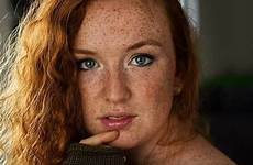 freckles gingers