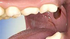 How Dental Implants Work 🤔 #dental #implant #adult #work #tooth | Zack D. films