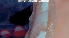Removing surgical tape and dressing from inner thighs….ouchhhhhh | Kenn Kendria