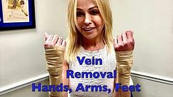 Hand Vein Removal, Arm Vein Removal & Foot Vein Removal
