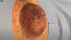 Large Epidermal Cyst Incision and Drainage
