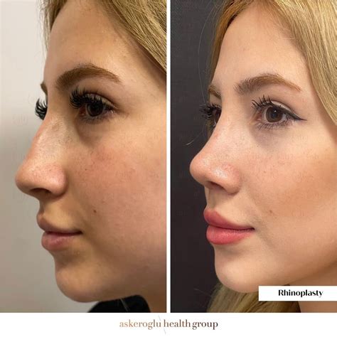 Rhinoplasty Package Turkey - Askeroglu Health Group