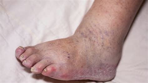 Blodpropp, også kalt trombose, er en fortykning (koagulasjon) av blodet i en blodåre. Posttrombotisk syndrom - NHI.no