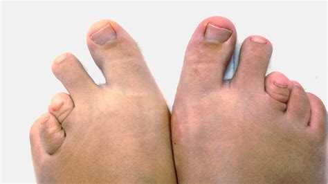 La onicomicosis es una infección en las uñas causada por hongos, que puede afectar tanto las manos como, con mayor frecuencia, los pies y especialmente las uñas de los pies. Uñas Largas Pies Feos Memes / El ranking de los pies más ...