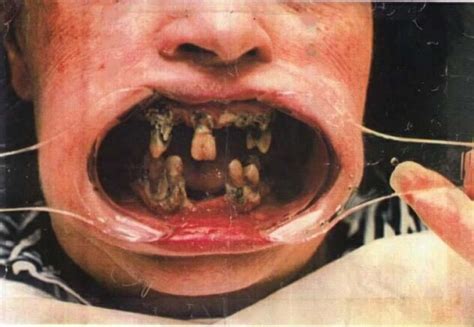 The british teeth trope as used in popular culture. One dish closer - Food corner