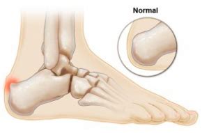 Three additional mutated alleles and establishment of. Haglund's Deformity - Perform Podiatry