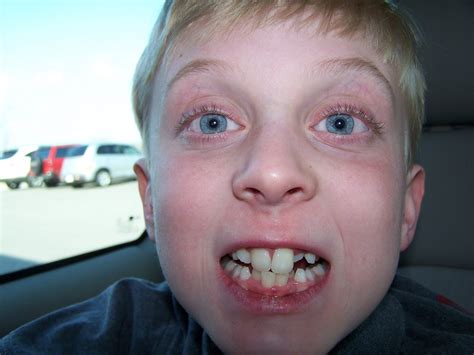 How to put rubber bands on braces with long nails. Judd Gets Braces!
