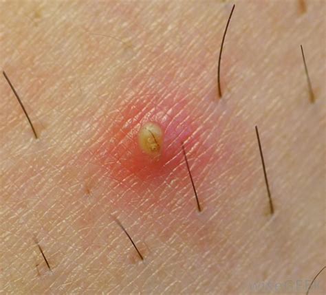 What is an ingrown hair? Pin on Faust