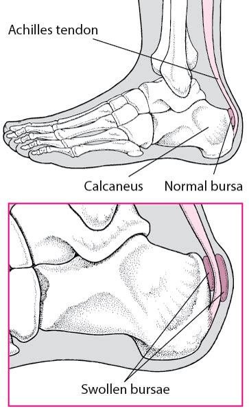 In the foot we have a unique situation in that between the shoes that we wear, and the ground that we walk. Achilles Tendon Bursitis - Bone, Joint, and Muscle ...