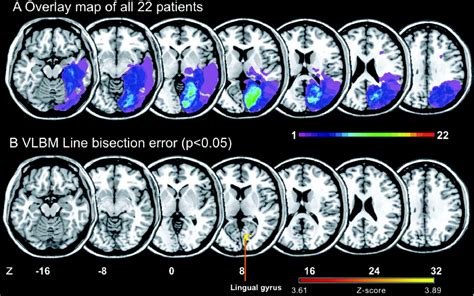 Line bisection unilateral neglect youtube. Line Bisection Error and Its Anatomic Correlate | Stroke