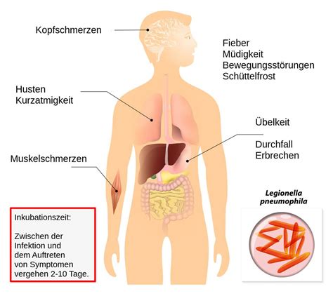 Die legionärskrankheit (legionellose, veteranenkrankheit) wird durch eine gruppe von bakterien, den so genannten. Legionellen Symptome Die typischen Anzeichen der ...