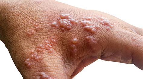 What is shingles? (with pictures) | Queensland Health