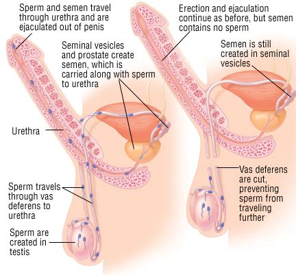 Milf sprayed in the mouth and she swallowed the tasty cum. Vasectomy - Harvard Health