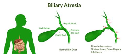 The biliary system, also called the biliary tract or biliary tree, is a system of ducts (narrow tubular structures) common maladies of the biliary system include gallbladder disease, biliary colic, and. Biliary Atresia-Causes, Symptoms, Signs, Treatment ...