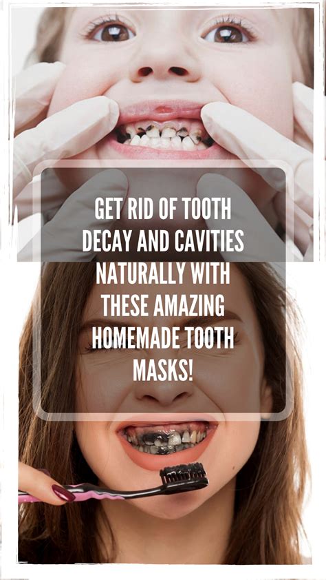 I tried gemzeez diy tooth gem kit at home!! Get rid of tooth decay and cavities naturally with these ...