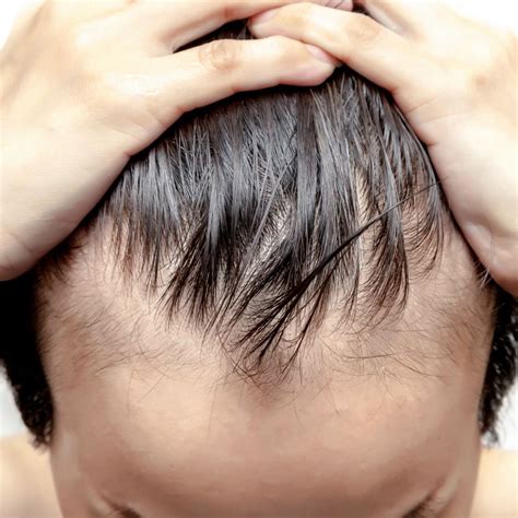 The most common symptoms of alopecia areata include patchy hair loss and nail changes, such as depressions in your fingernails, vertical ridges along your nails and rough nail texture. Pin em Beauty | Hair Loss