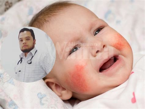 Penyakit mozaik adalah penyakit tanaman yang disebabkan oleh virus tmv ( tobacco mozaic virus ). Doktor Ini Kongsi Rawatan Asas Penyakit ECZEMA Yang Mak ...