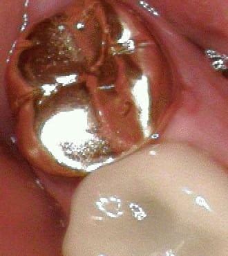 When getting a new dental crown, zirconia versus gold is the great debate. Dental Crowns Rock Hill SC | Cranford Dental