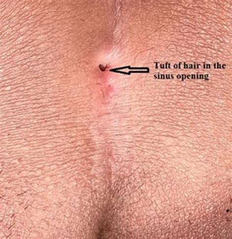 A pilonidal cyst is almost always located near the tailbone at the top of the cleft of the buttocks. Pilonidal sinus with tuft of hair projecting from the ...