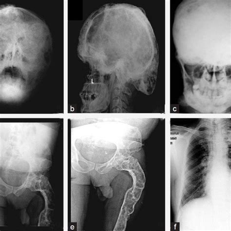 Ray (2021) is a netflix one of the best web series, which is based on drama as per the imdb genres. Conventional radiography (a) X-ray PNS face showing ...