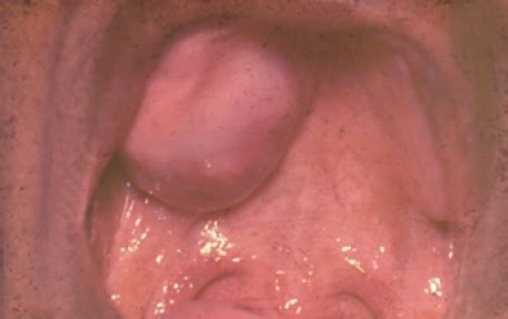 Tiene un incidencia máxima en la cuarta década de la vida. cirugia buco maxilo facial: adenoma pleomorfo en paladar y ...