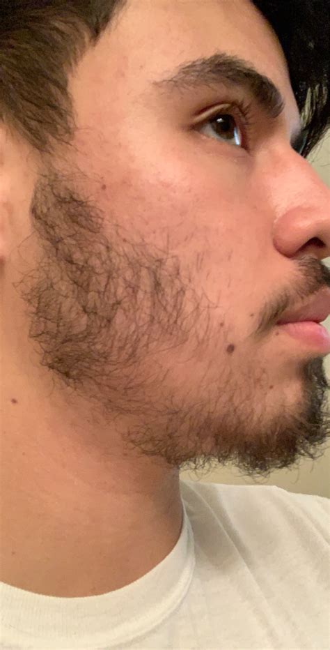 It might be caused by a medical condition that can be treated. 17 Year Old Growing Facial Hair Progress - Page 2 - Beard ...