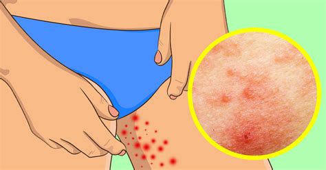 I got a small rash on my inner, upper thigh after being out on the lake all day several weeks. 10 Effective Ways to Prevent a Rash on the Inner Thighs