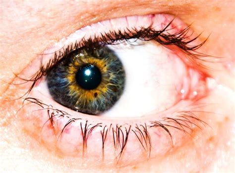 Central heterochromia around the pupil, sectoral heterochromia in a segment of the iris, and complete heterochromia in which both eyes are differently colored. Central Heterochromia - Heterochromia A Beautiful Anomaly ...